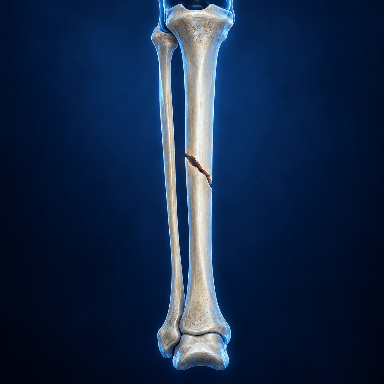 Educational illustration of a tibial fracture